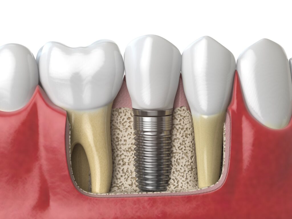 how is bone grafting performed
