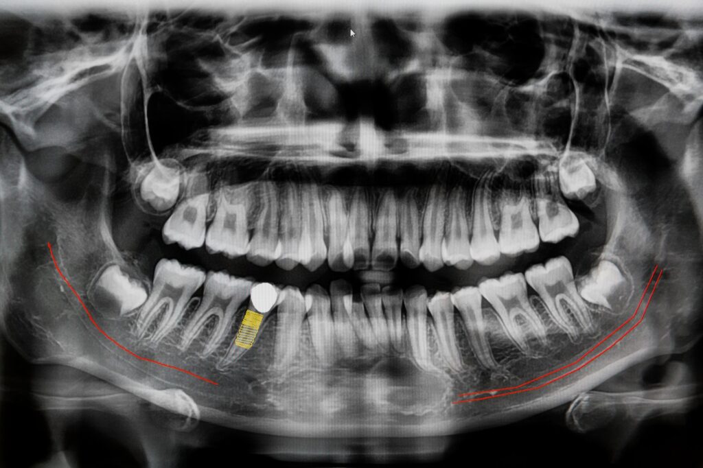 process of dental bone graft surgery