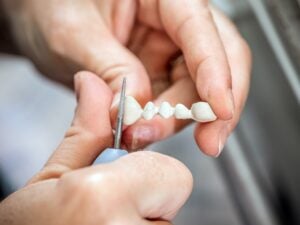 what are dental bridges