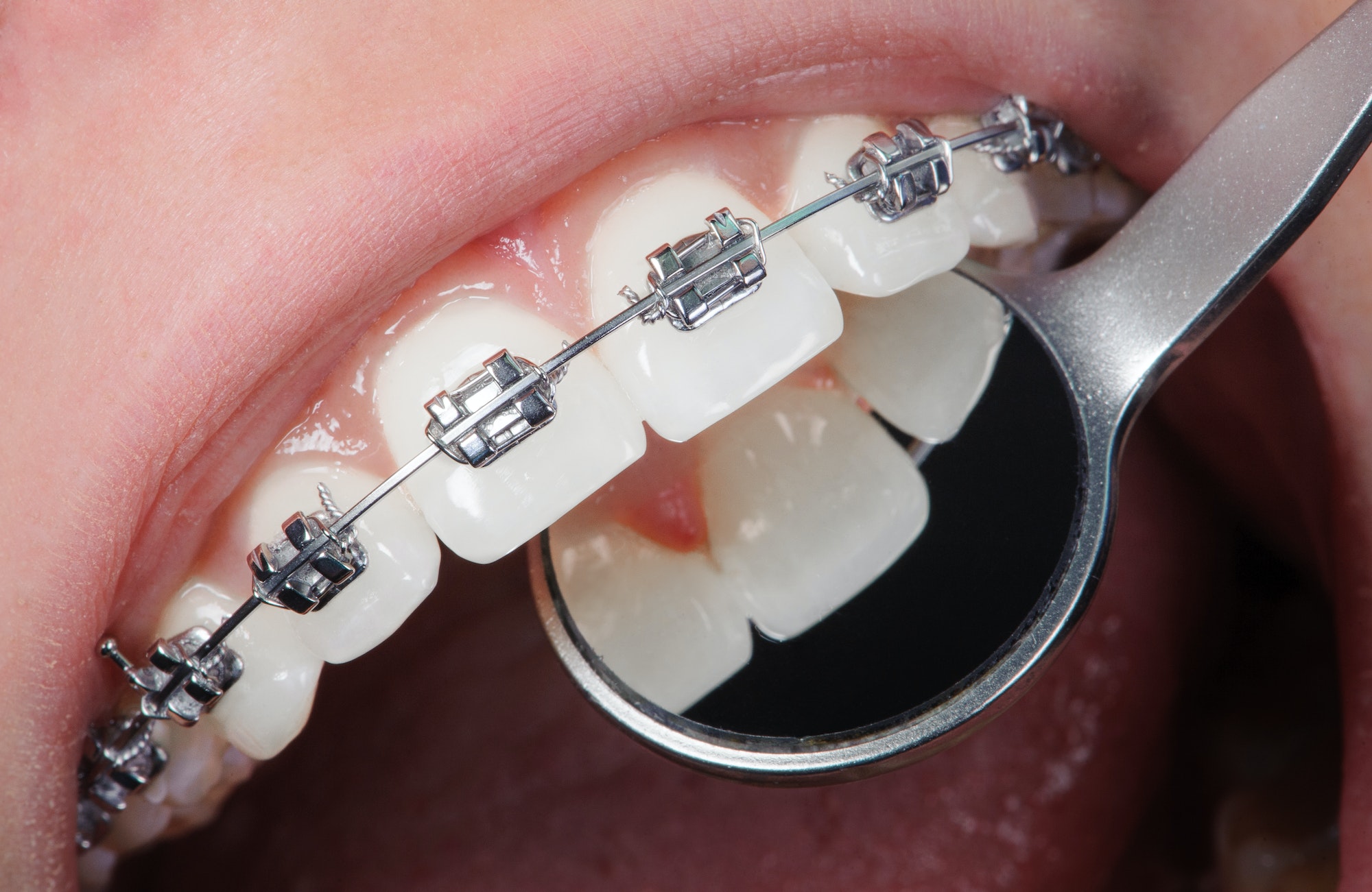 The Medical Benefits Of Braces According To Top Dentists
