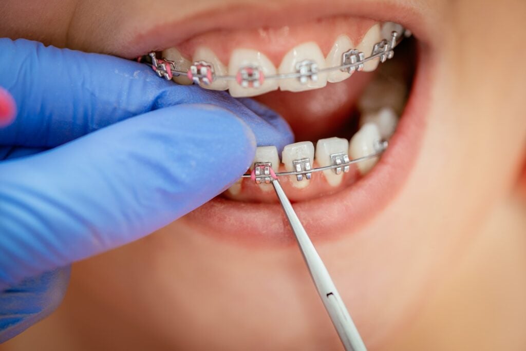 Facts about braces