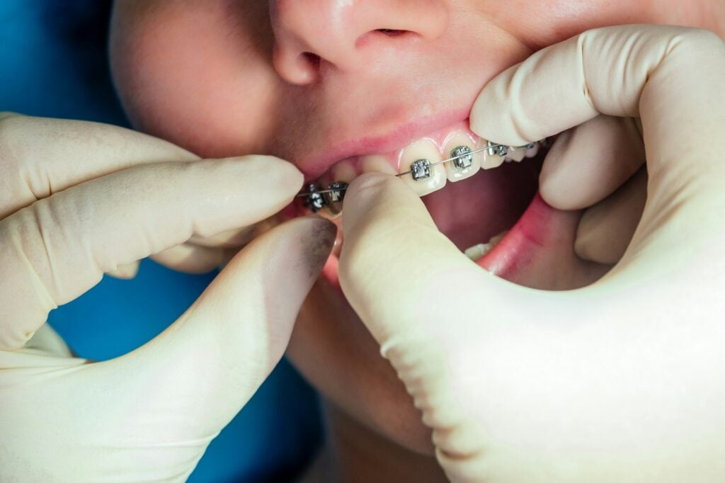 playing sports with braces