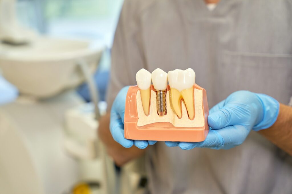 Gloved dentist holding a model of a dental implant between two natural teeth