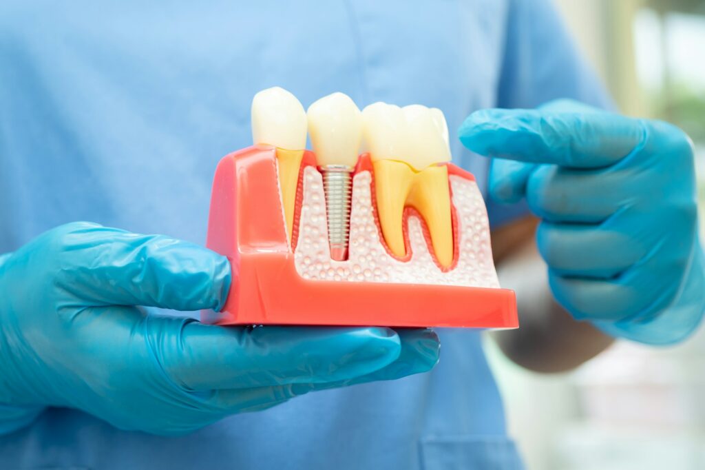Dentist holding a cross-section model of an implant beside a natural tooth root