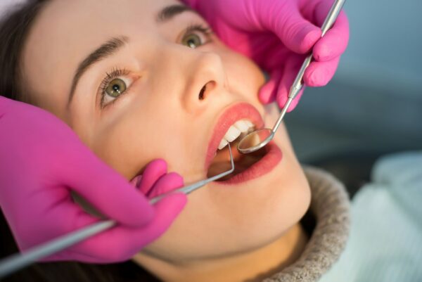 A tooth-colored filling being placed at Icon Dental Center in Everett