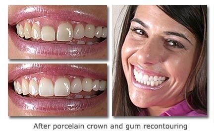 Before and after image of gummy smile corrected with crown lengthening