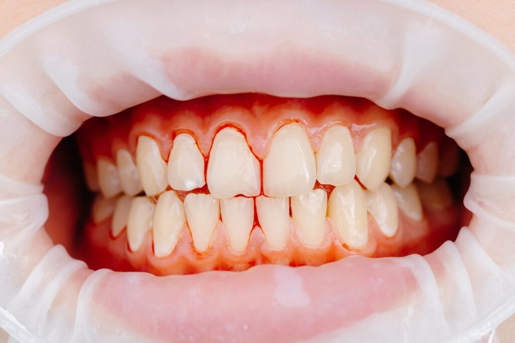 Stages of gum disease from gingivitis to periodontitis explained by Icon Dental Center