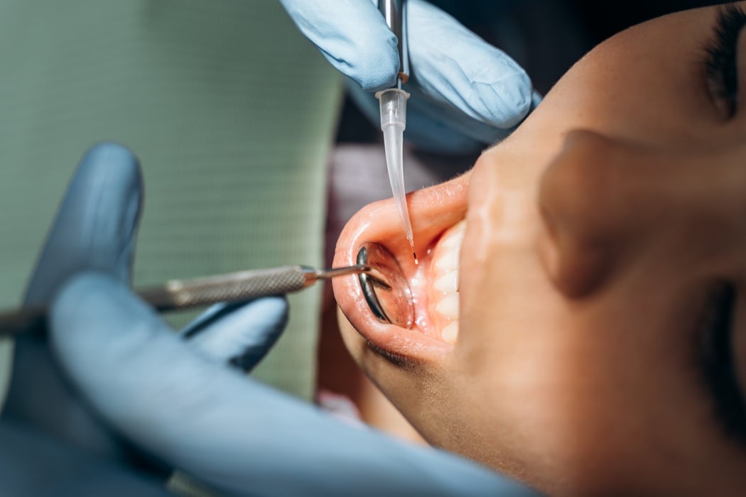 Dental instruments working at a patient's gum line during treatment